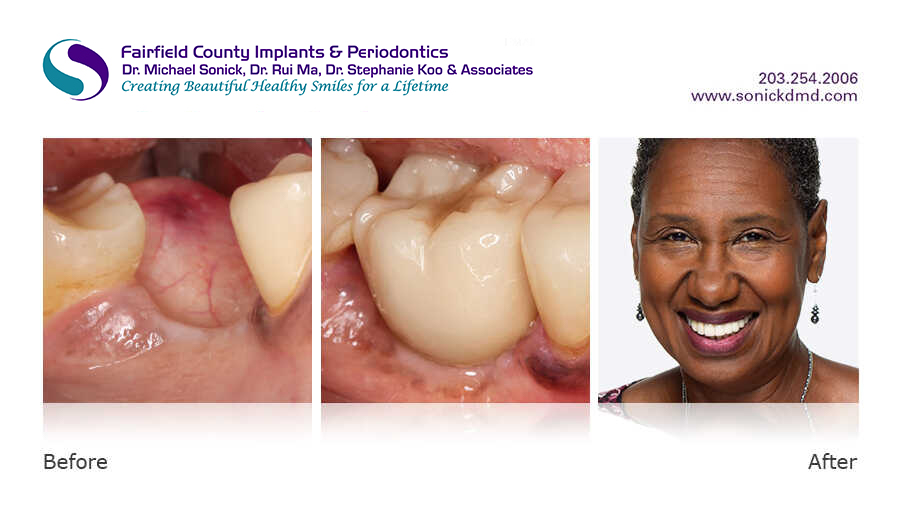 Before and after patient photos