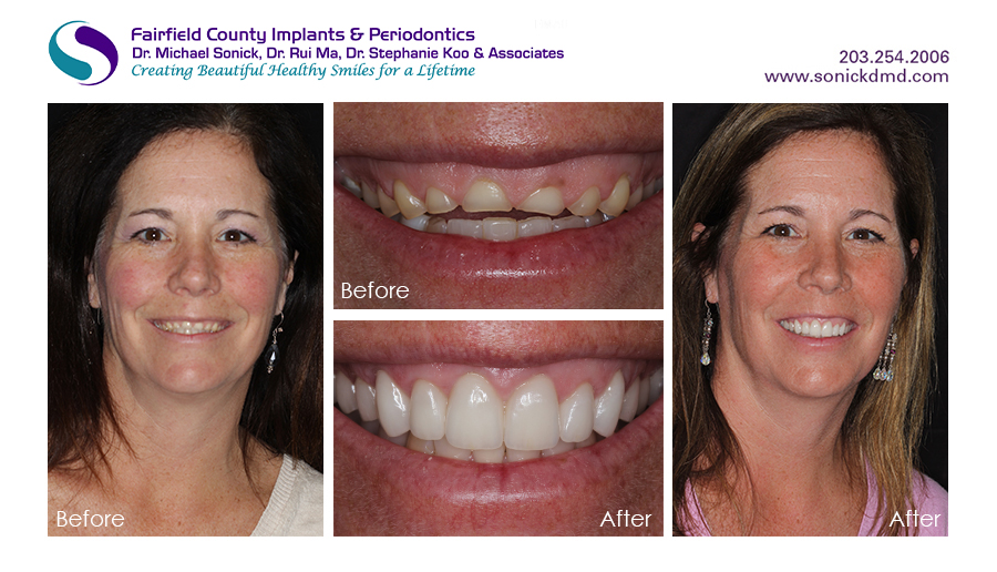 Before and after patient photos