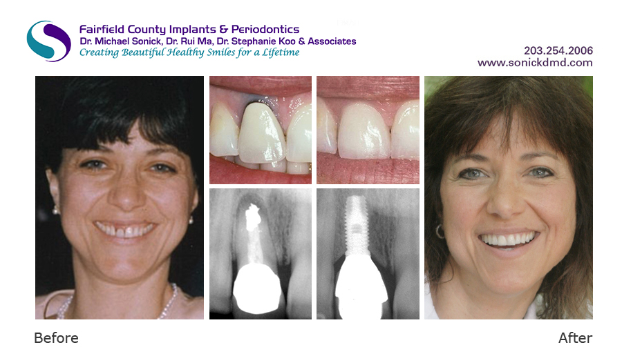 Before and after patient photos